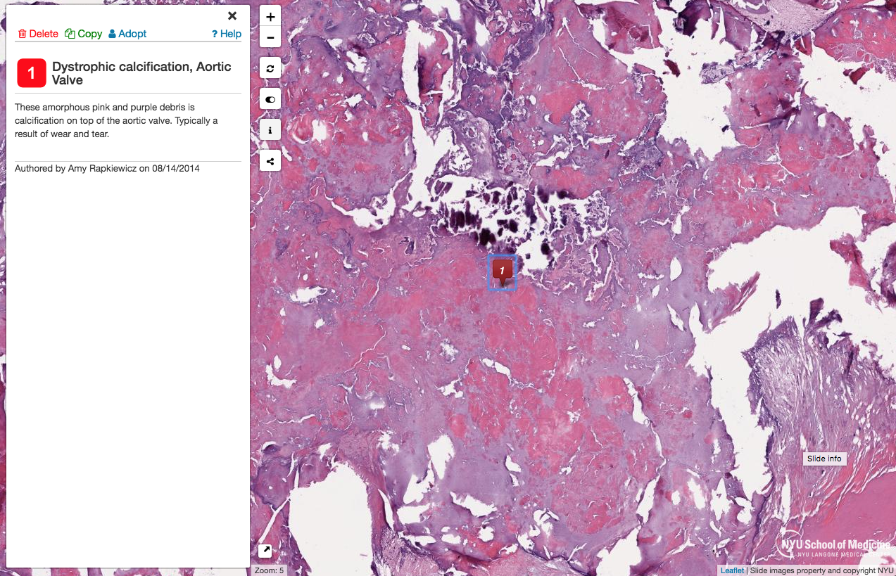NYU Virtual Microscope Shows Calcification of Aortic Valve