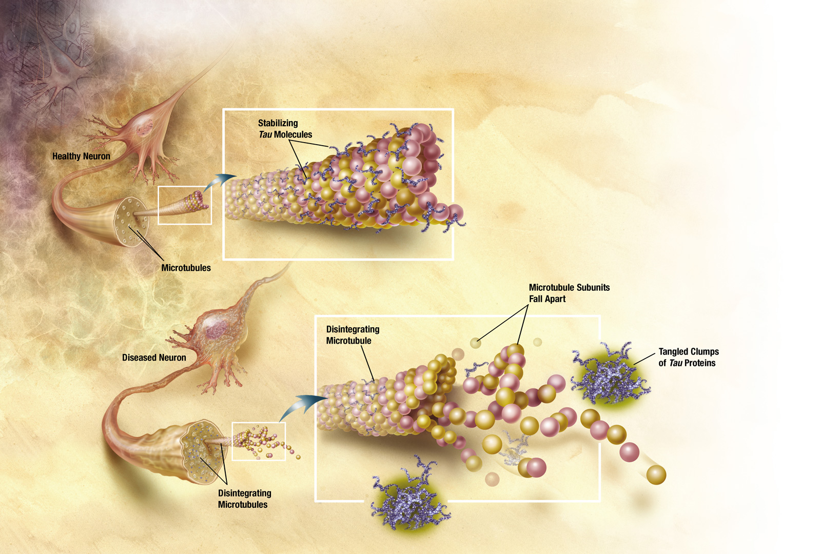 Stabilizing Tau Molecules in a Healthy Neuron Support Microtubules in a Normal Brain.  Chemically Altered Tau Proteins Collapse, Causing Microtubules to Disintegrate and Tangled Clumps of Tau Proteins to Appear