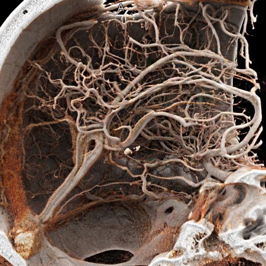 Radiology Fellowships NYU Langone Health