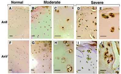 Grid of Ten Microscopic Images Showing Annexin II and V Expression in Normal, Moderately Osteoarthritic, and Severely Osteoarthritic Cartilage