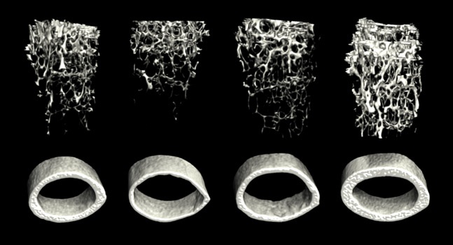 A Series of Four Micro-CT Images Showing Varying Degrees of Resorption of Trabecular and Cortical Bone