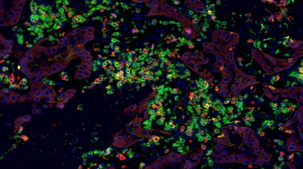 Microscopic Image of a Lung Adenocarcinoma Tumor