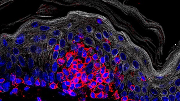 Microscopic Image of Malignant T Cells