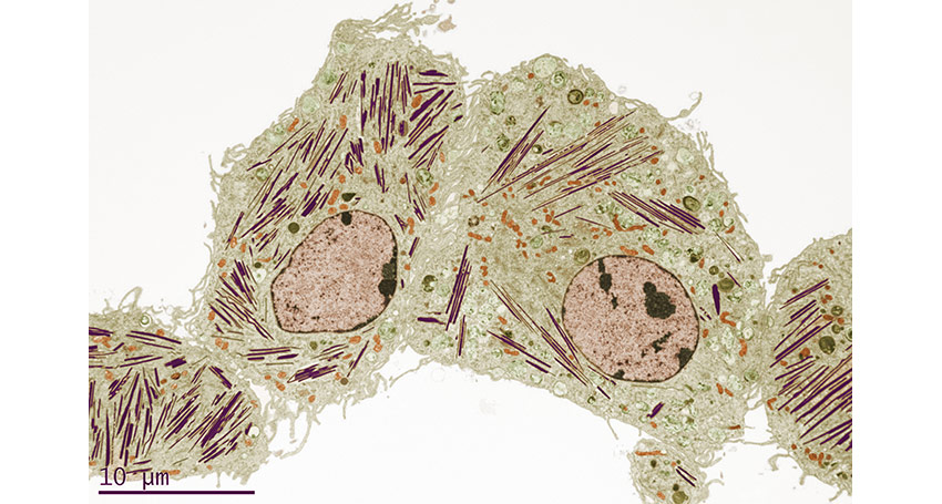 Lung Cell in Mouse with Gaucher's Disease