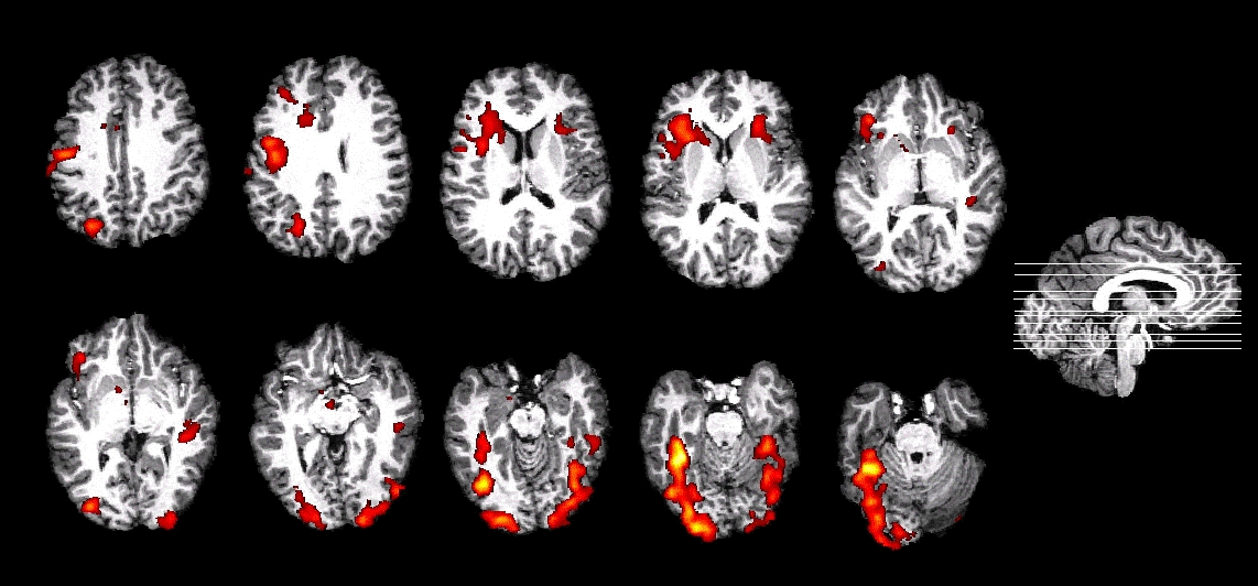 Functional Magnetic Resonance Imaging Thesen Lab