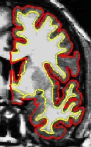 Figure 3: Pial and white matter surfaces are used to quantify cortical thickness across cortex